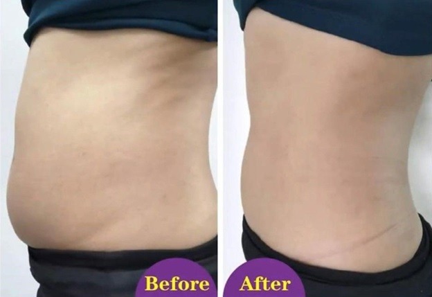 Intense Fat Burning Treatment