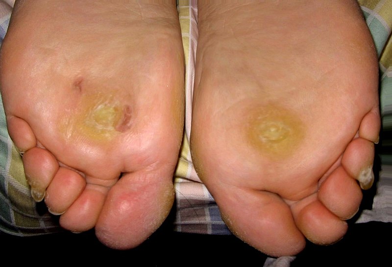 Recurrent plantar warts