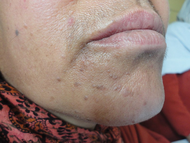 Verruca plana (flat warts) on the chin