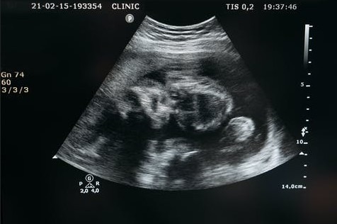 Undescended testicles