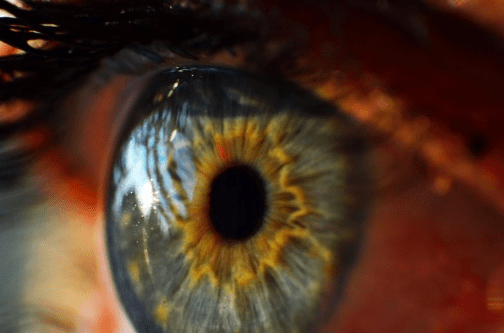 Weakening cornea