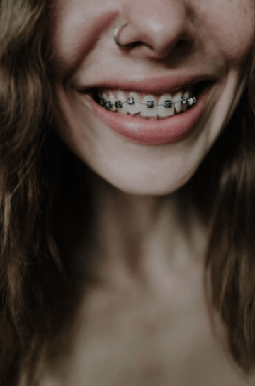 a woman smiling wide and showing her dental braces 