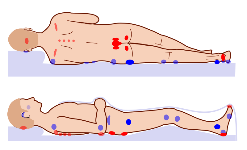 Pressure ulcer points