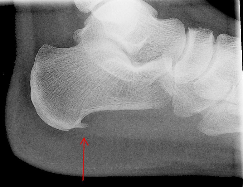 Projectional radiography of calcaneal spur